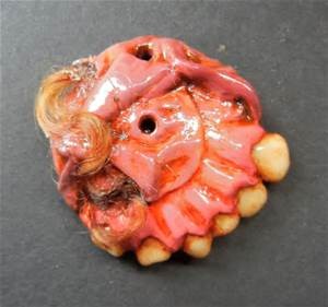 teratoma